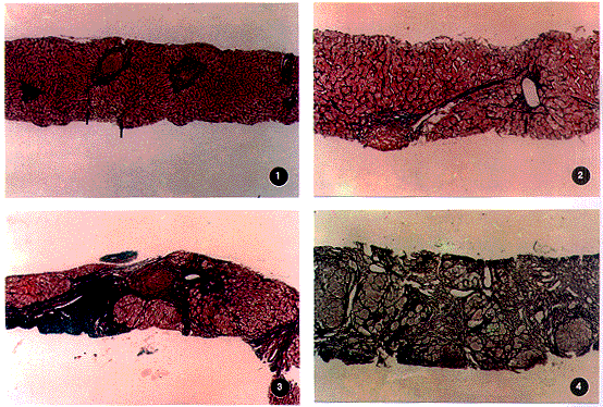 ���Ը�����֢��ȼ���ά���̶ȼƷַ���