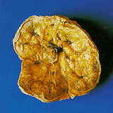 Dried Human Placenta