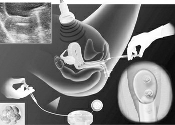 孕育试管里的爱情硕果