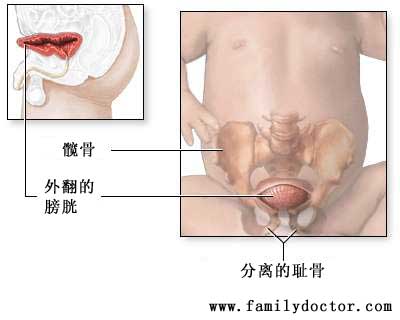 膀胱外翻是由于膀胱前壁和骨盆发育异常，导致膀胱暴露于腹壁，病人常合并有耻骨分离。患有这种先天性疾病的儿童需要行膀胱外翻修复术，部分患儿的膀胱经修复后功能可以完全恢复，但严重的病例则不能完全修复膀胱。<br>手术目的：<br>*预防可影响肾功能的感染<br>*让患儿恢复正常的排尿功能<br>*改善患儿身体的外观<br>*预防将来性功能异常