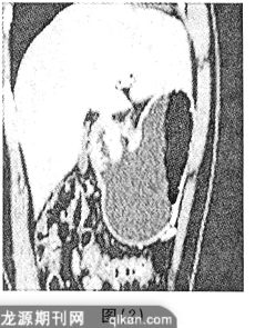 胃癌在影像学(DC CT)诊断中的价值